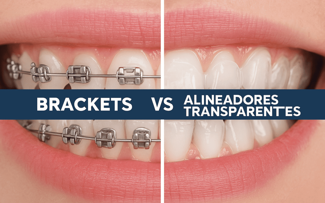 Invisalign vs Brackets: ¿Cuál es la mejor opción para alinear tu sonrisa?